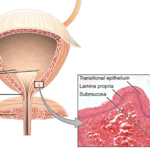 Human bladder. Some 13 million Americans suffer from incontinence.