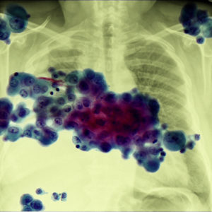 Slide of mesothelioma and xray.