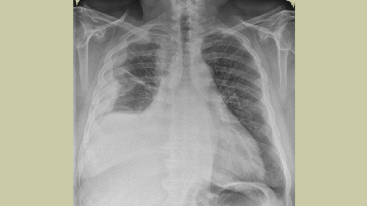 X-ray of mesothelioma patient.