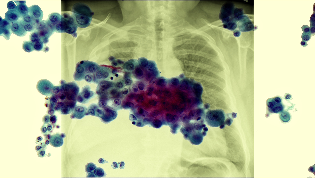 Slide of mesothelioma and xray.