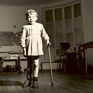 A child with polio, 1950s.