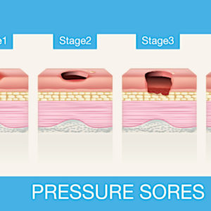 Stages of Pressure Sores