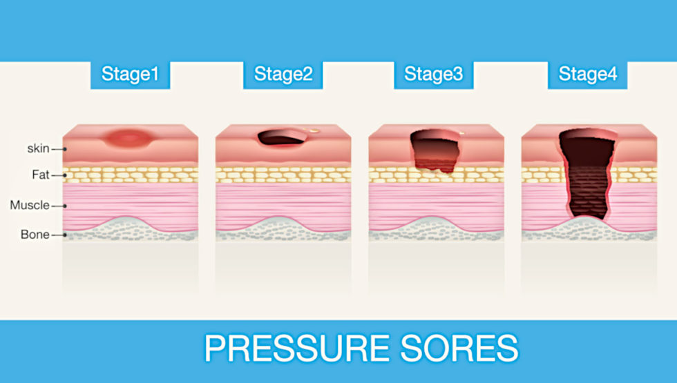 Tips for Differentiating Between Pressure Injuries and Moisture ...