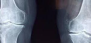 xray inage of knee bones for Radiologic and Imaging Nurses Day