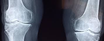 xray inage of knee bones for Radiologic and Imaging Nurses Day